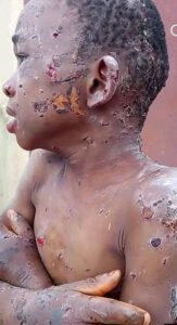 The abused Chiziterem with burnt all over his body
